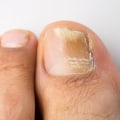 Will probiotics help with toenail fungus?