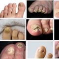 How do i know if i have toenail fungus or not?