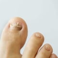 Does toenail fungus turn brown?