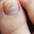 How do you know if your toenail fungus is gone?