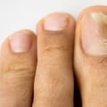 Does toenail fungus turn brown when it dies?