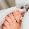 How long does it take for toenail fungus to go away with treatment?