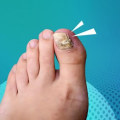 What is the most effective treatment for severe toenail fungus?