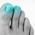 The Thickening of Toenails: A Comprehensive Overview