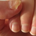 Discoloration of the Nail: Visual Symptoms