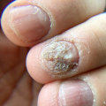 What does it mean when nail fungus turns brown?