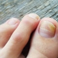 Can toenail fungus be completely cured?
