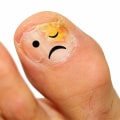 Can toenail fungus be permanent?