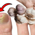 The Power of Garlic Extract for Toenail Fungus