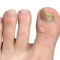 Tips to Keep Feet Clean and Dry for Toenail Fungus Prevention