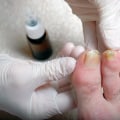 Can changing diet heal a fungal toenail?