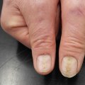 Understanding Damage to the Nail Bed