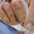 Should you dig out toenail fungus?