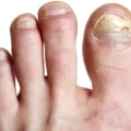 The Benefits of Oregano Oil for Toenail Fungus