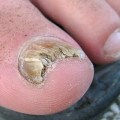 What does dead toenail fungus look like?