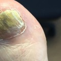 Can toenail fungus be cured without oral medication?