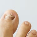 Can toenail fungus clear on its own?