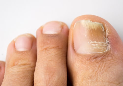 Will probiotics help with toenail fungus?