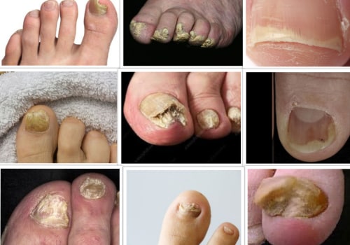 How do i know if i have toenail fungus or not?