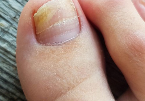 How do you know if your toenail fungus is gone?