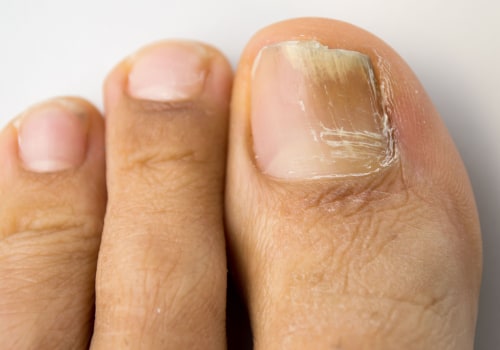 Does toenail fungus turn brown when it dies?