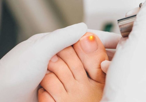 How long does it take for toenail fungus to go away with treatment?
