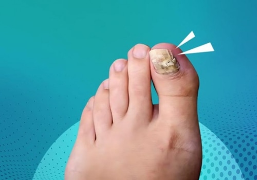 What is the most effective treatment for severe toenail fungus?