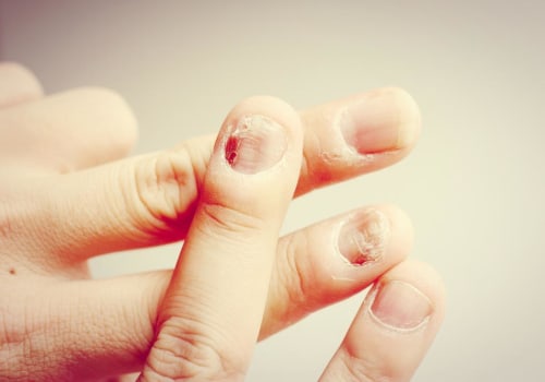 How do you get rid of nail fungus without medication?