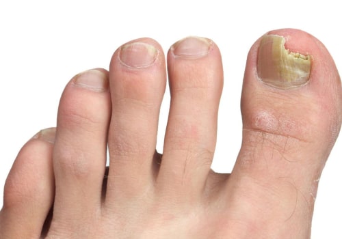 How do i get rid of toenail fungus without going to the doctor?