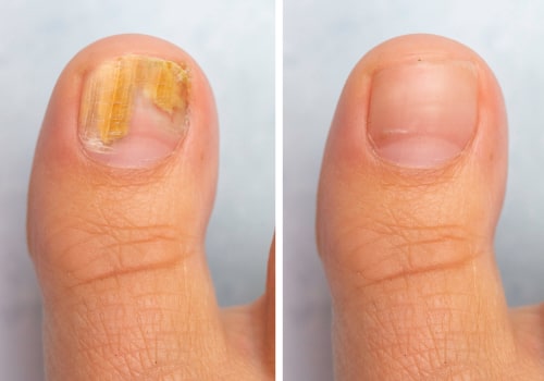 Will toenails ever be normal after fungus?