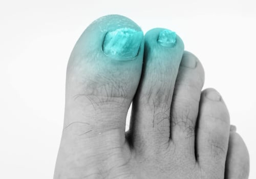 The Thickening of Toenails: A Comprehensive Overview