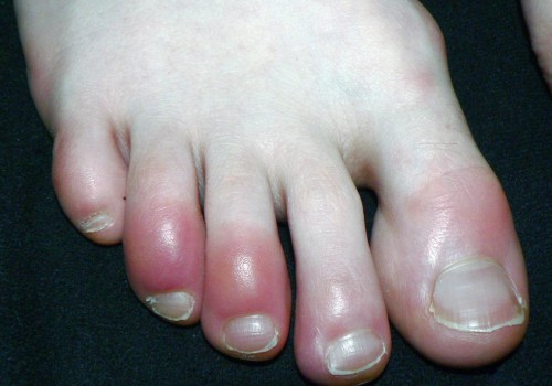 Injury to Toe or Finger: Causes, Risk Factors, and Treatment