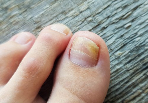 Will toenail fungus grow out?
