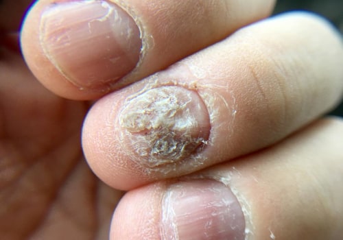 What does it mean when nail fungus turns brown?