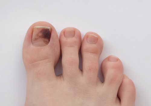 How do you get rid of brown toenail fungus?