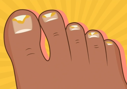 Avoid Sharing Footwear: A Prevention Strategy for Toenail Fungus