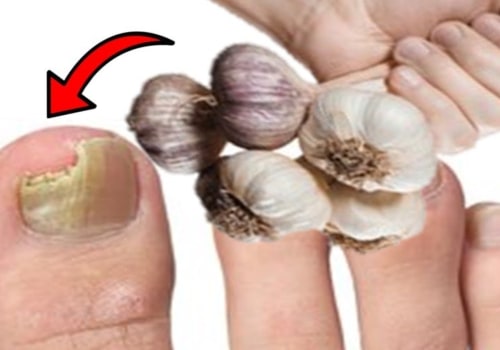 The Power of Garlic Extract for Toenail Fungus