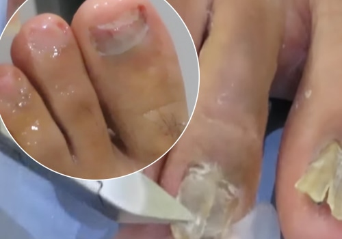 Should you dig out toenail fungus?