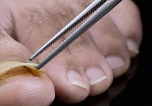 The Smell of Toenail Fungus: Causes, Effects, and Treatments
