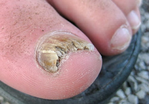 What does dead toenail fungus look like?