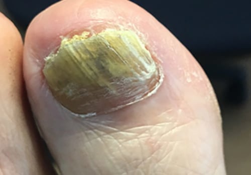 Can toenail fungus be cured without oral medication?